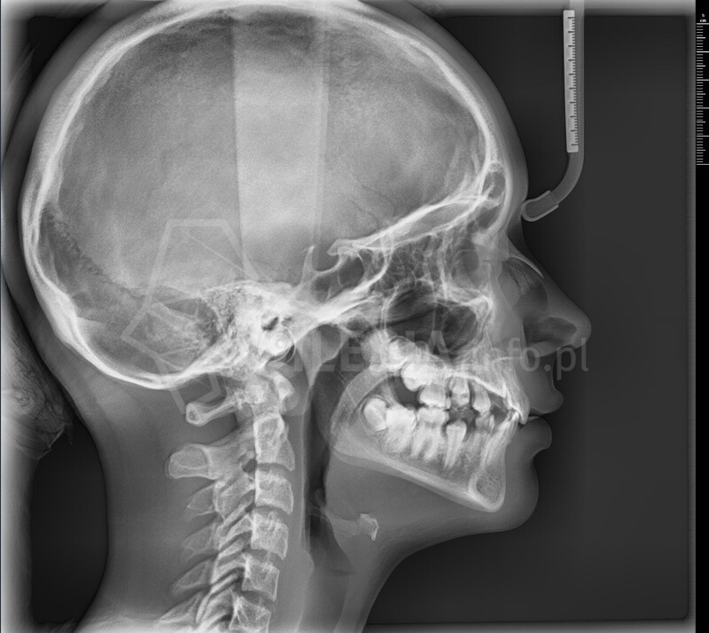 RTG stomatologiczne, CBCT od 100 zł Świętochłowice