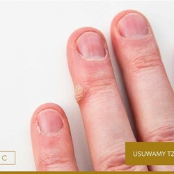 Usuwanie włókniaków i brodawek w Katowicach? Dojedziesz do nas w 20 minut.